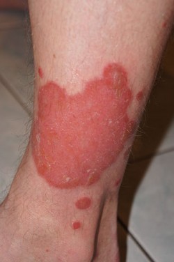 Psoriasis involves dry, inflamed patches of skin that become hard and scaly before ultimately sloughing off (Wikimedia Commons)