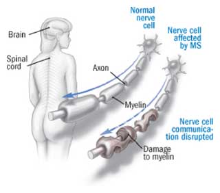 A healthy neuron compared to one undergoing myelin loss and scarring (© life-in-spite-of-ms.com)