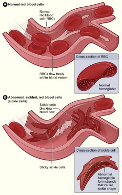 Sickle Cell Disease Pain May Be Managed 1