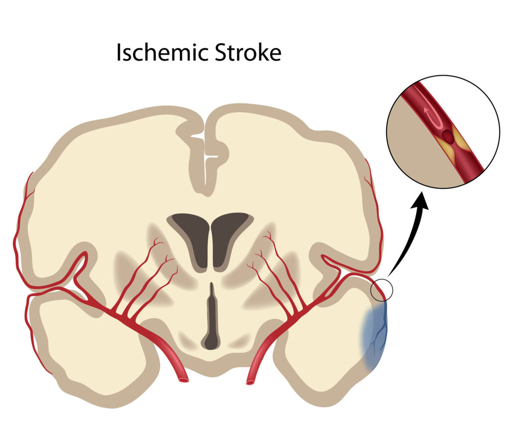 Cannabis and Cerebrovascular Accident (Stroke)