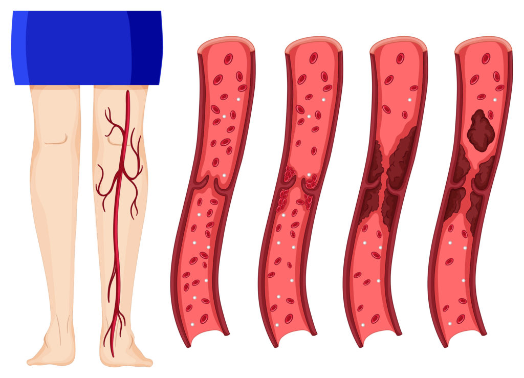El cannabis y el accidente cerebrovascular