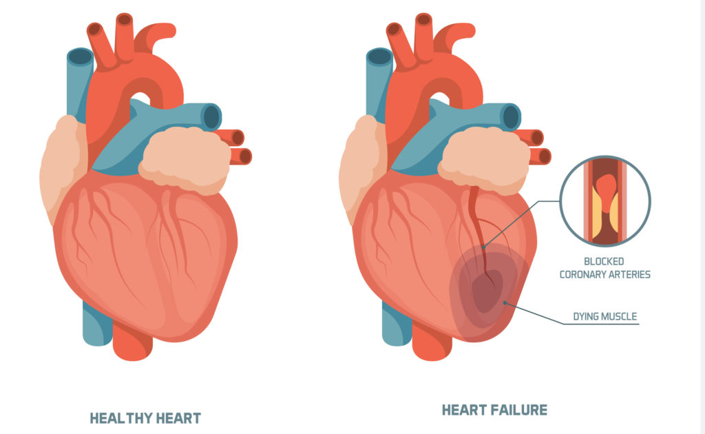 Cannabis and Cerebrovascular Accident (Stroke)