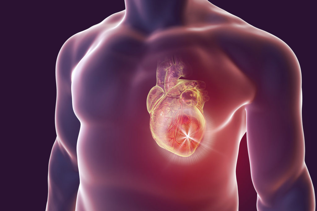 El riesgo de accidente cerebrovascular se incrementa enormemente durante el mes siguiente a un ataque al corazón