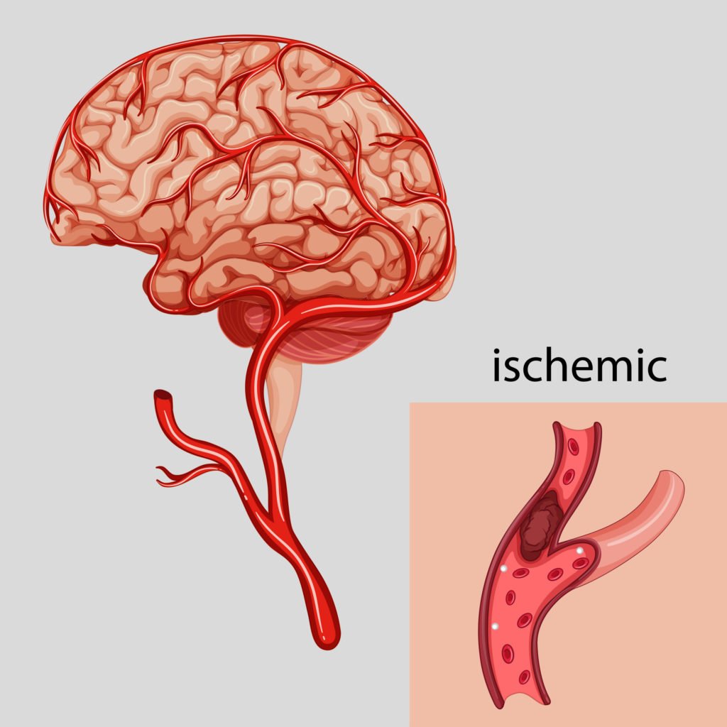 El accidente cerebrovascular isquémico puede ocurrir si se interrumpe el suministro de sangre al cerebro, por ejemplo a causa de un coágulo de sangre