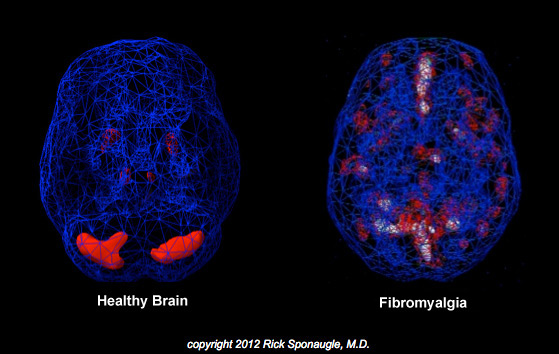 Ein gesundes Gehirn im Vergleich zu dem eines Fibromyalgie-Patienten