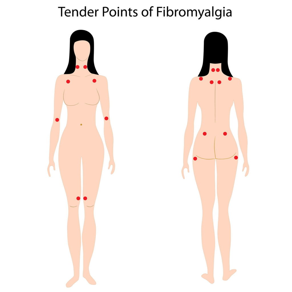 Empfindliche Punkte der Fibromyalgie