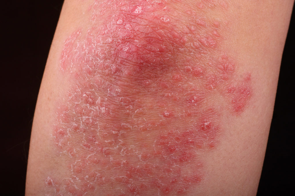 La psoriasis implica inflamaciones, más o menos circulares, de piel seca que se endurecen y finalmente forman escamas que luego se desprenden