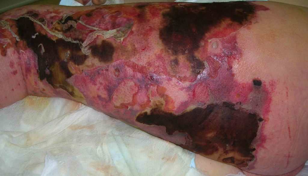 Un hombre de 36 años de edad, sin antecedentes de consumo de tabaco, desarrolló lesiones necróticas en los dedos de los pies