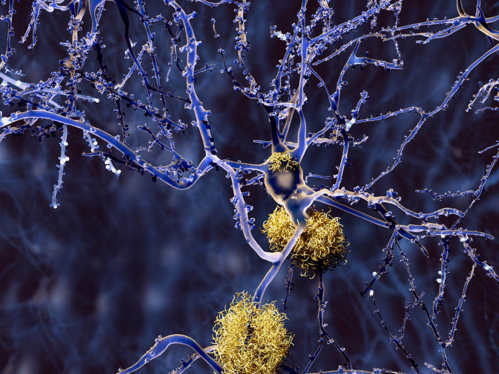 Um gráfico científico que representa os neurônios com placas amilóides, um traço encontrado na doença de Alzheimer. Os neurônios são roxos e finos, com ramos menores emergindo deles. As placas são laranja-claras, densas e lembram um ninho espesso.