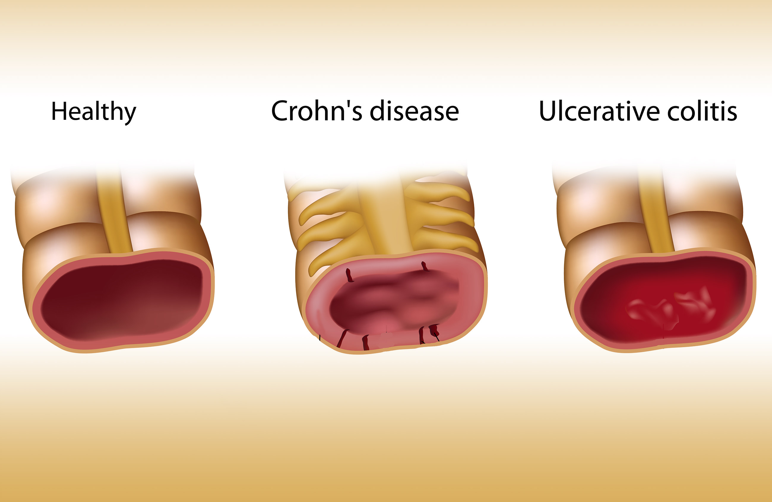 What Causes Dickcheese