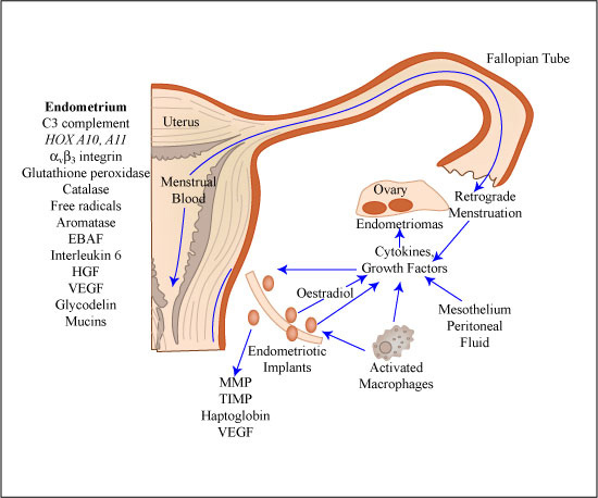Model of endometriosis development (©Mitopencourseware)