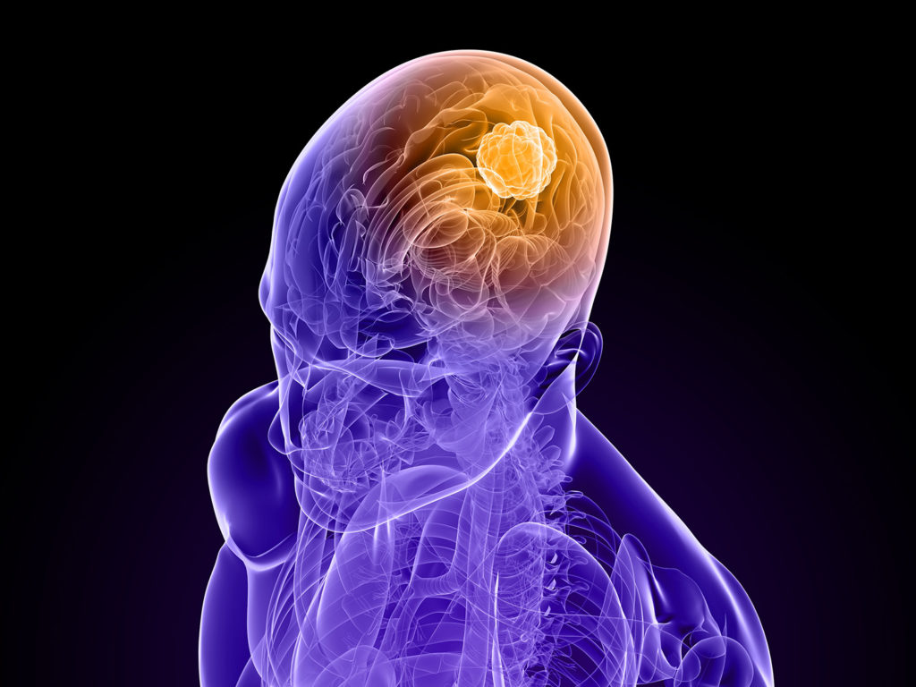 Las investigaciones recientes revelan que los cannabinoides podrían ayudar a reducir drásticamente las formas de cáncer cerebral