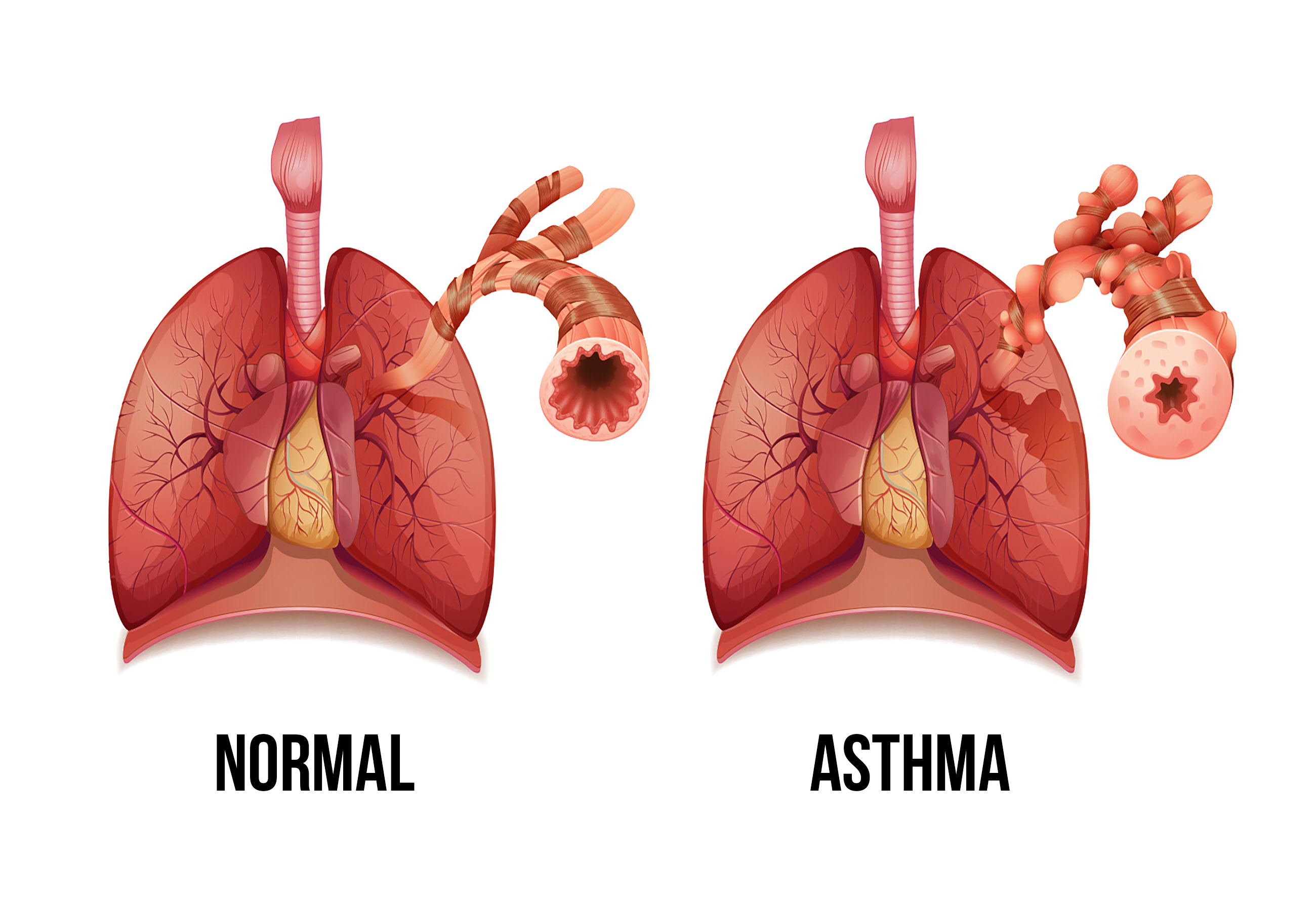 Бронхит латынь. “Asthma bronchial….” (Бронхиальная астма):. Легкие при астме. Бронхи астматика. Легкие при бронхиальной астме.