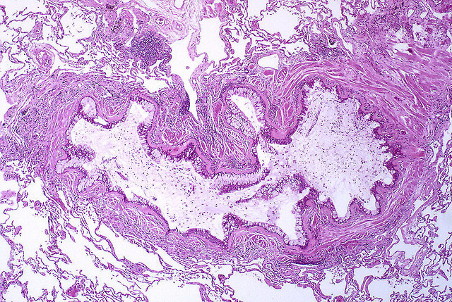 Cannabinoid receptors have been found in human lung tissue (© Pulmonary Pathology)