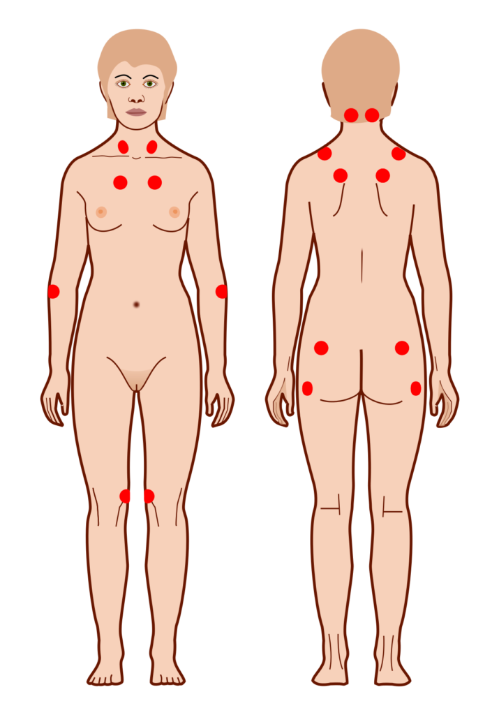 Fibromyalgie en ME zijn nauw verwante aandoeningen, waarbij de eerste meer wordt gekenmerkt door pijn en de laatste door vermoeidheid