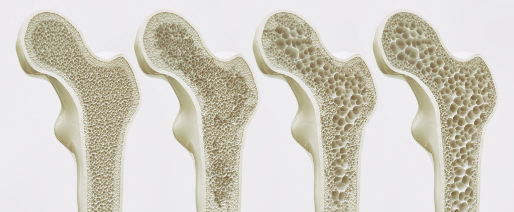 En la osteoporosis, la hiperactividad de los receptores CB en los osteoclastos produce una reabsorción ósea excesiva