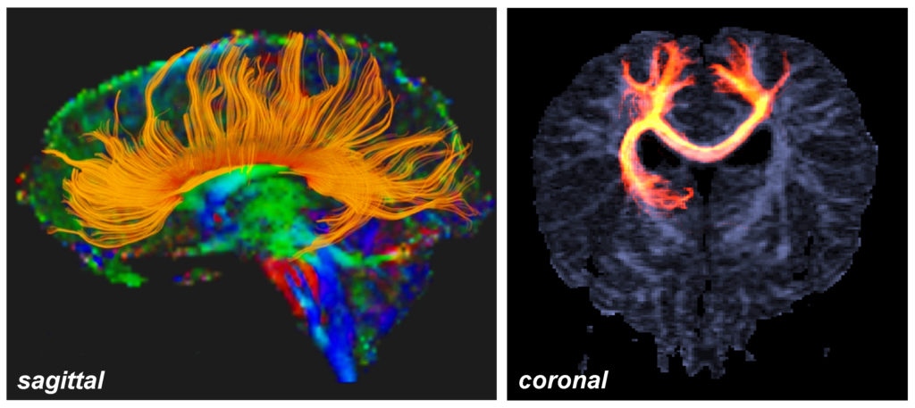 DTI imaging of the corpus collosum