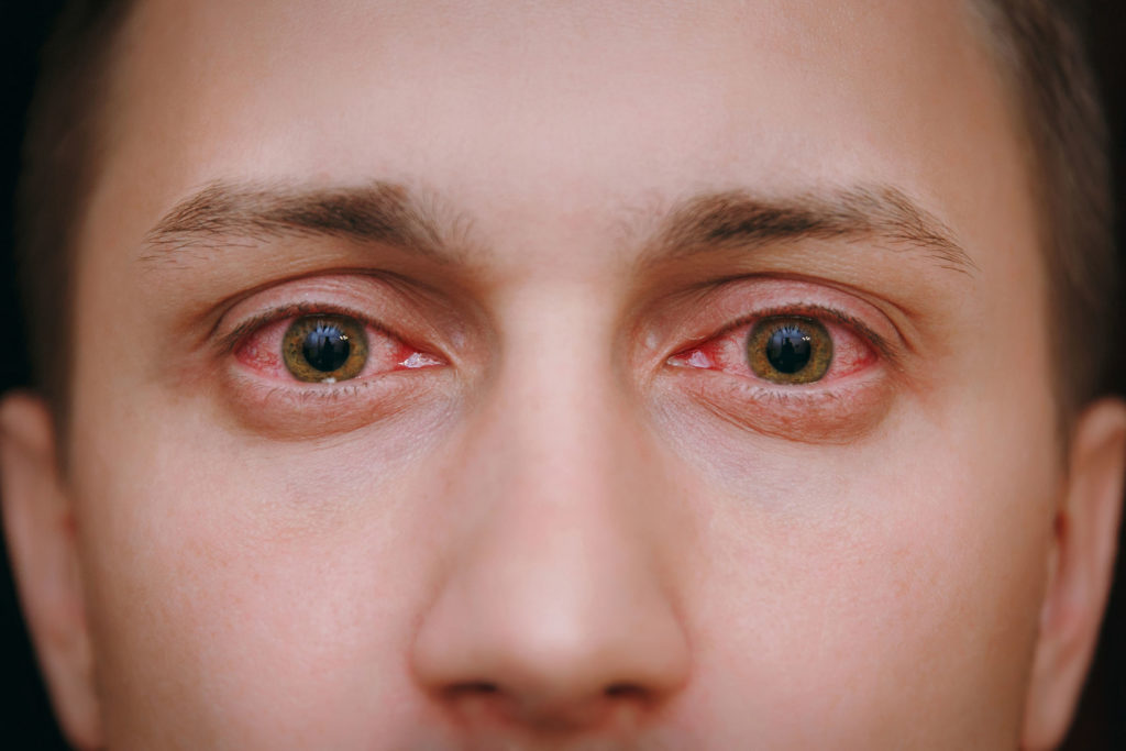 The definitive guide to cannabis allergy