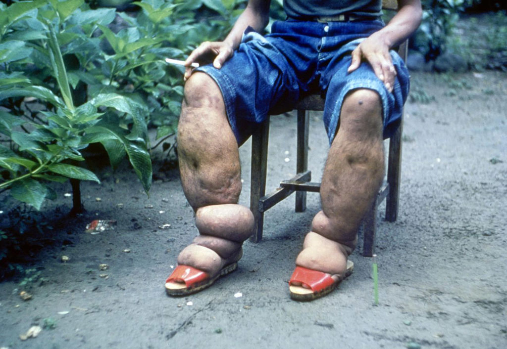 L’éléphantiasis, une complication commune entraînée par les filaires