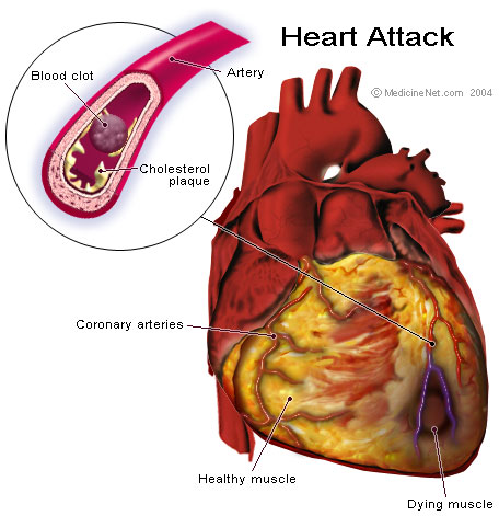 El CBD también puede ayudar a proteger contra las enfermedades coronarias y otras enfermedades cardiovasculares (© gandhiji40)
