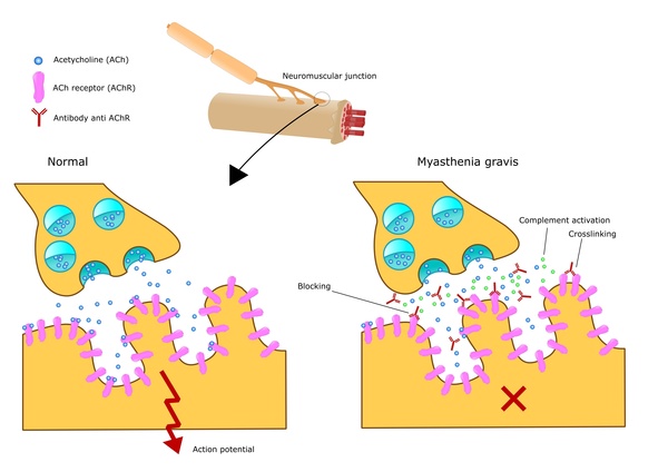 Myasthenia gravis tast het presynaptische zenuwuiteinde aan (© US National Institute of Health)