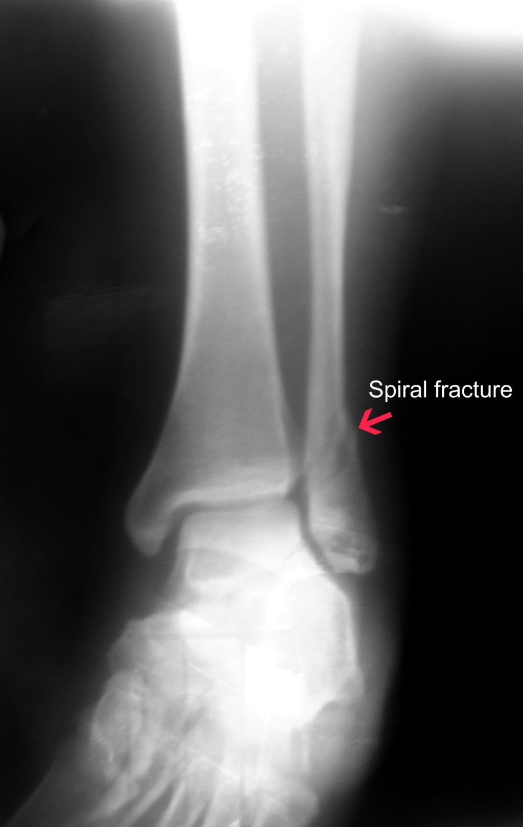 cannabis-its-potential-for-treating-bone-injuries-disease