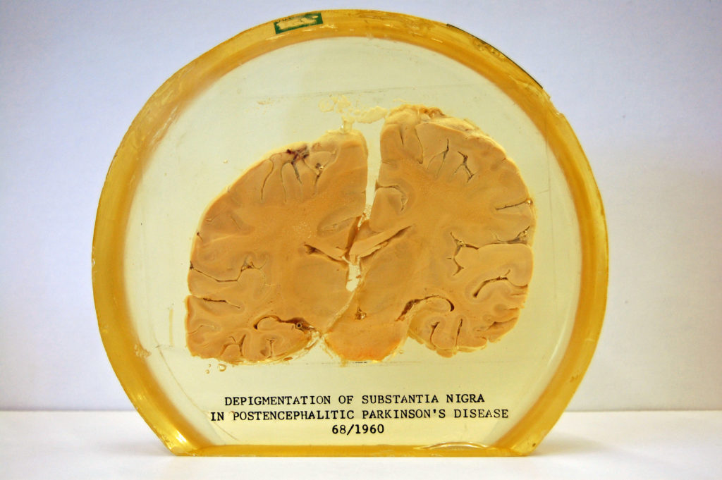 Een foto van een deel van de hersenmassa geconserveerd in een heldere substantie, geëtiketteerd als “Depigmentatie van Substantia Nigra in postencefalitische Parkinson 68/1960”.