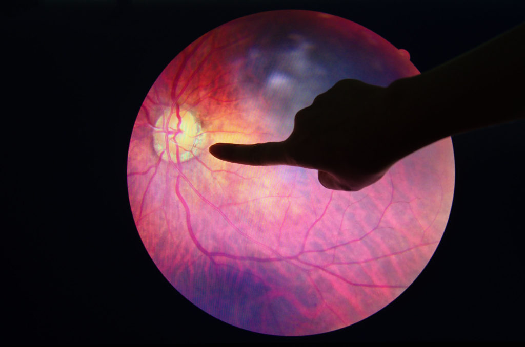 A person pointing at diabetic retinopathy picture