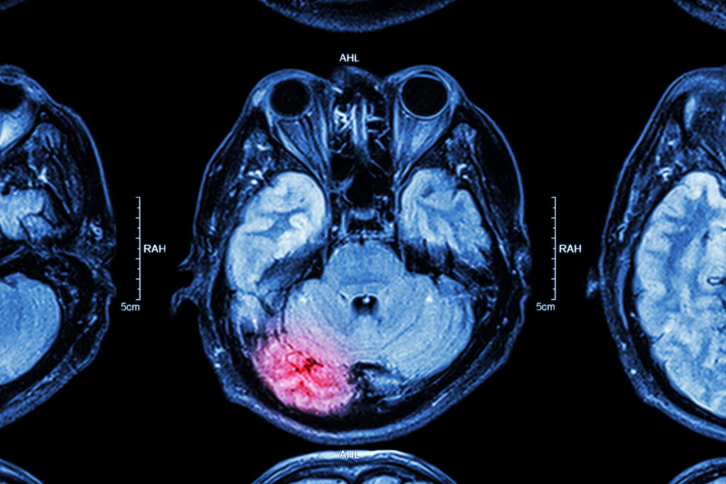 Cat scan of a brain that’s been damaged