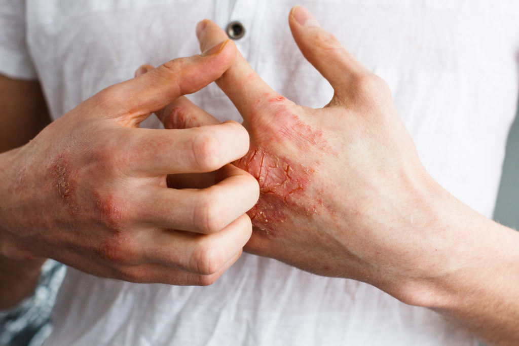 Die Hand einer Person mit Psoriasis oder Ekzem in einem weißen Hemd