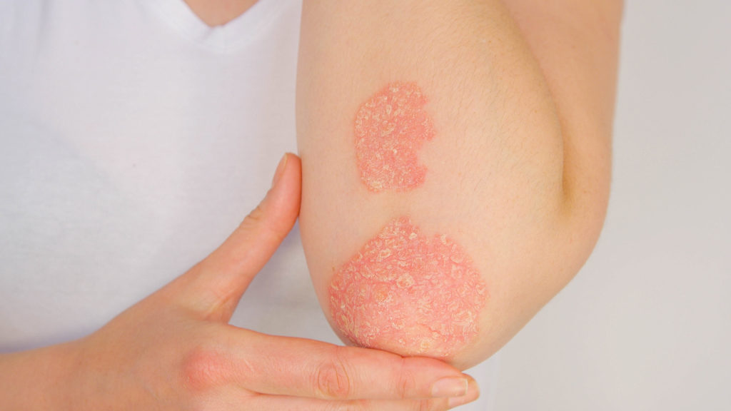 Eine Frau mit Psoriasis auf ihrem Unterarm