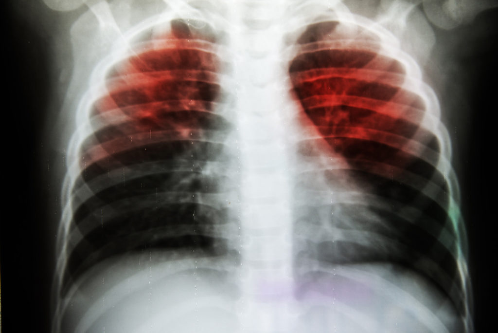 An x-ray of a pair of lungs with two areas highlighted in red