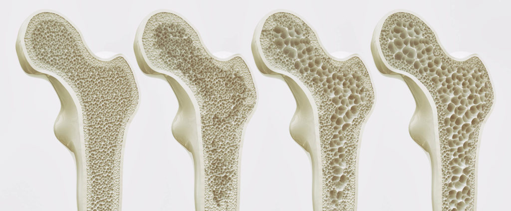 Una sección transversal vertical de los huesos que muestran etapas de osteoporosis.