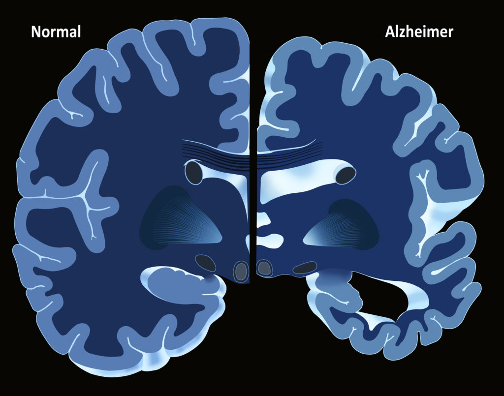 El cerebro sano y de Alzheimer contra el fondo negro