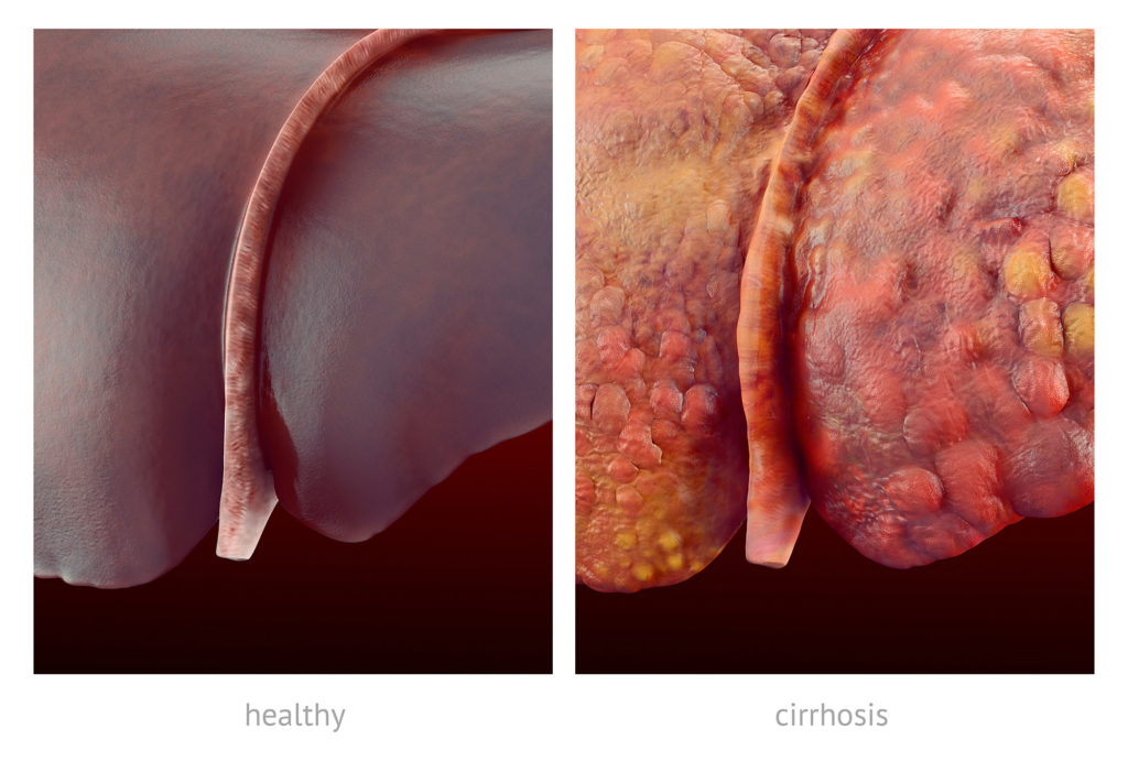 A healthy liver and a liver affected by cirrhosis