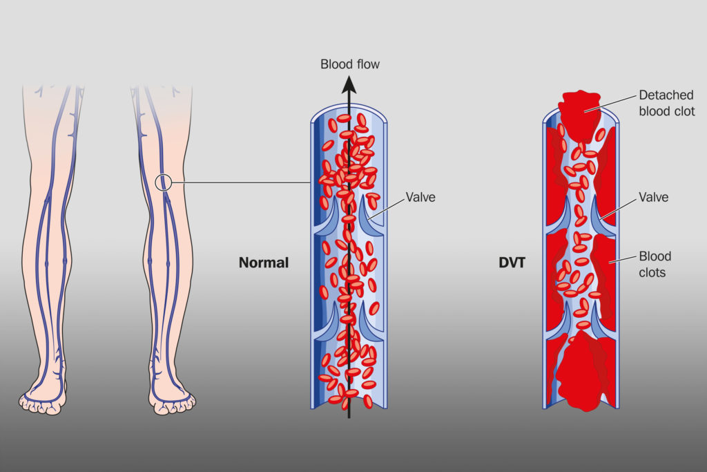 A normal blood vessel and a blood vessel with thrombosis