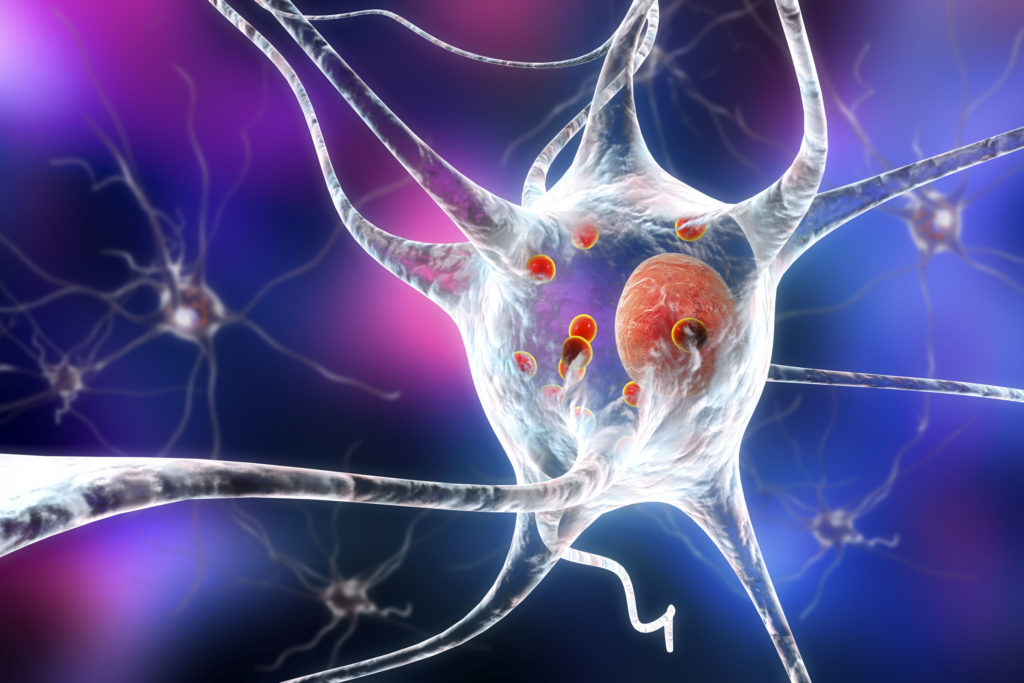 An illustration of neuron with dysfunction