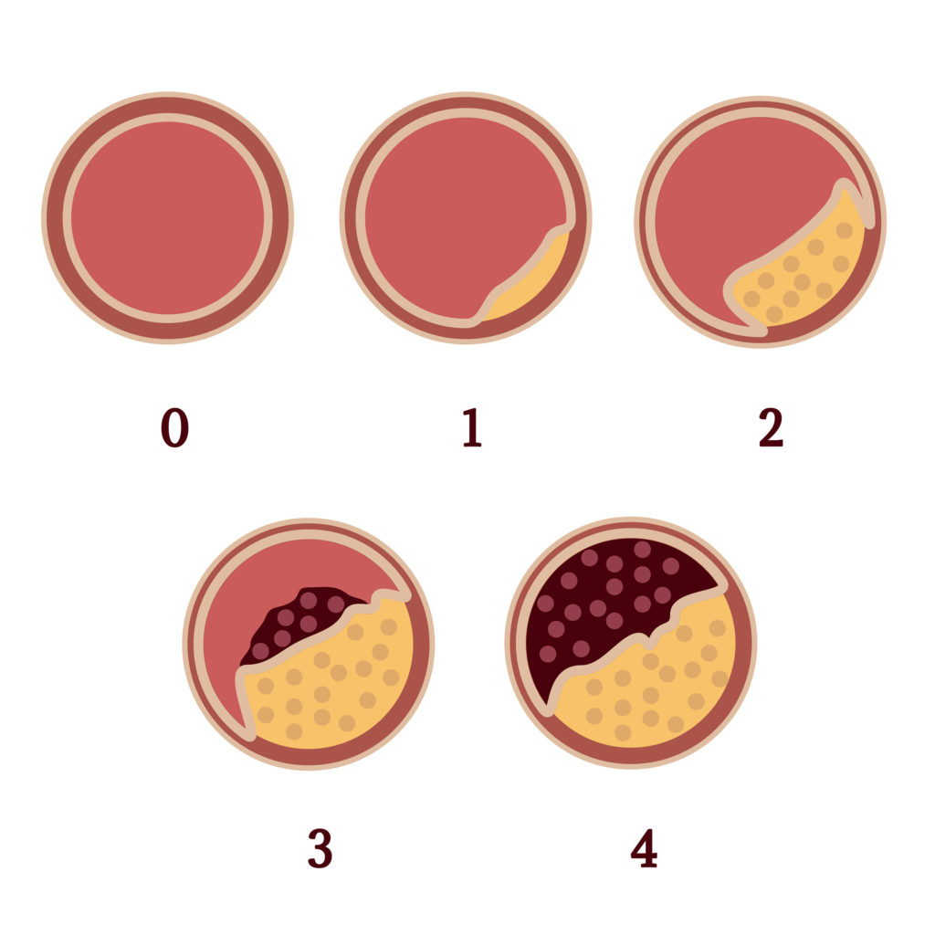 An animated ilustration of vasoconstriction