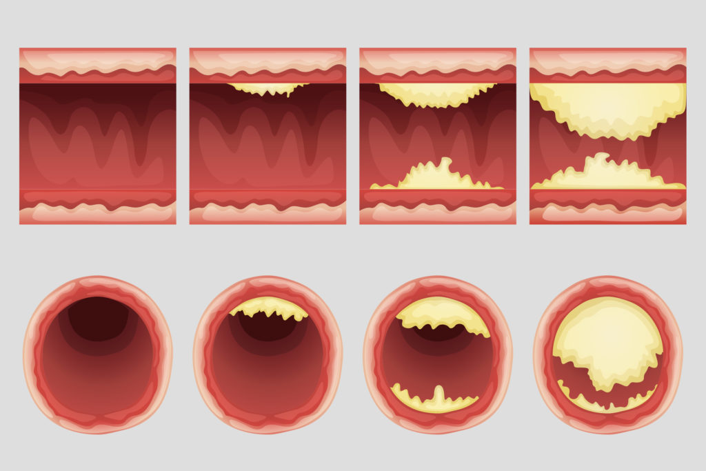 Four arterial walls with different levels of atherosclerosis