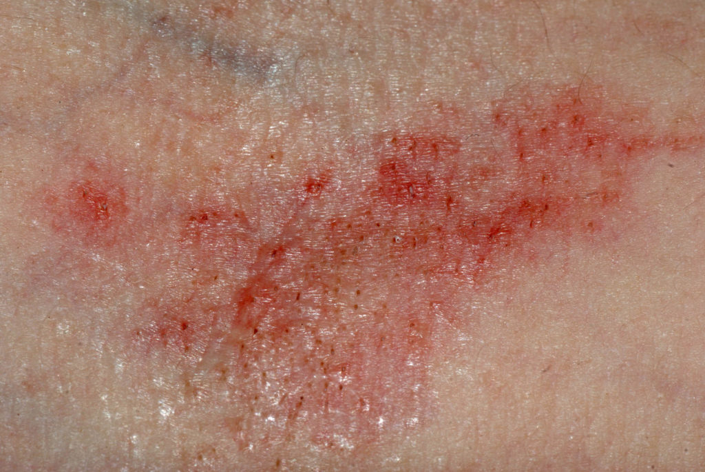 A red rash on skin