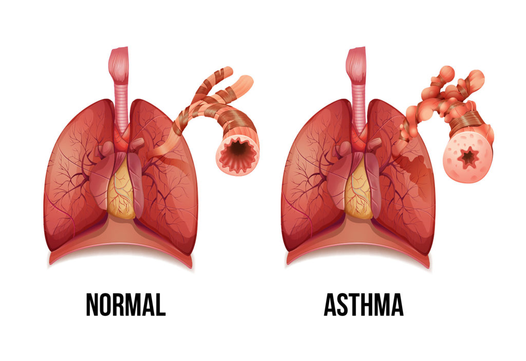 Un poumon normal et un poumon asthmatique