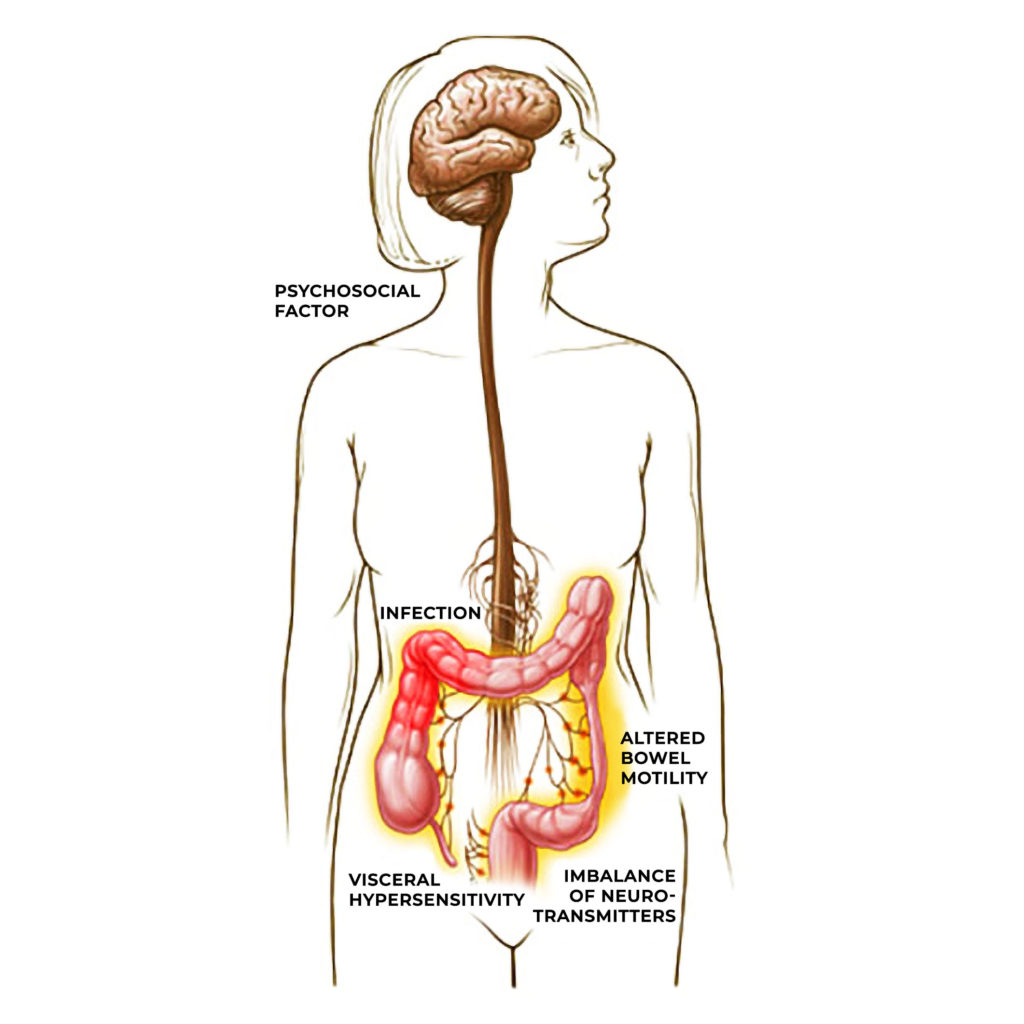 Illustration of postulated causes of IBS