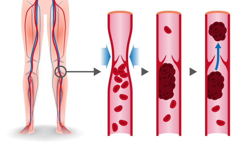 An animated ilustration of leg and thrombosis