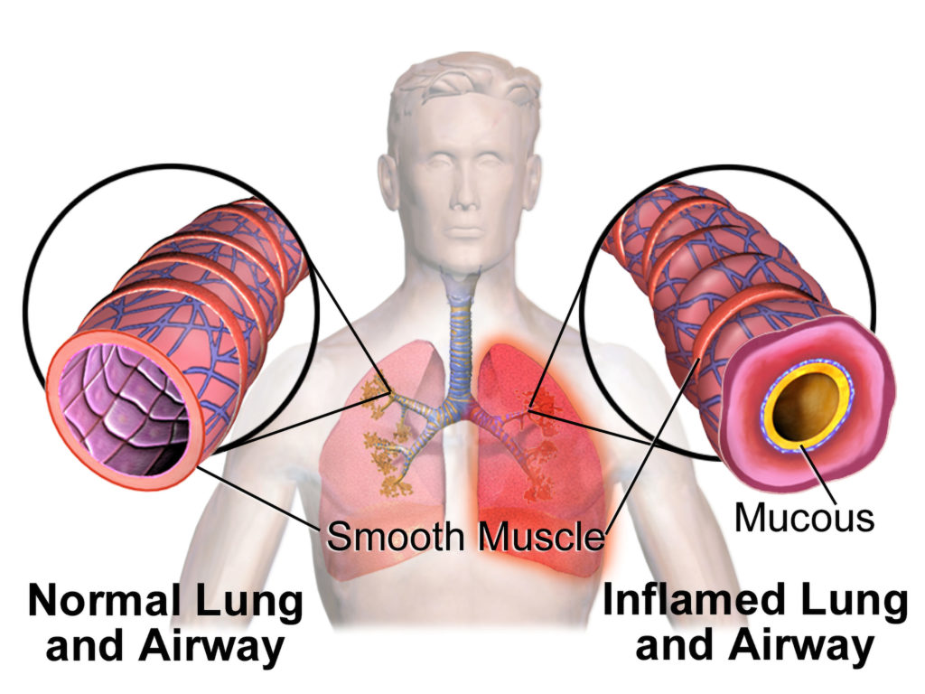 Inflamed animated human lungs caused by mixing cannabis and tobacco 