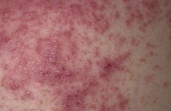 Eine schwere Kontaktdermatitis, die die typische Rötung und den erhöhten, beulenartigen Hautausschlag zeigt