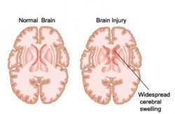 Brain damage following an acute event such as IS or TBI occurs in part due to inflammation (Mahesh Kumar)