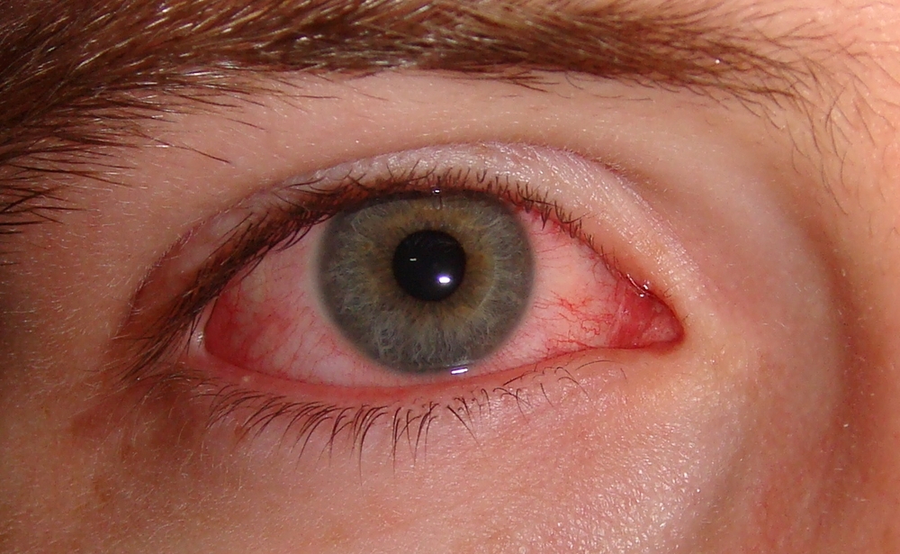 Wie den Kreisen unter den Augen entgeht