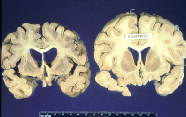 Das Hirn einer Person, die an TSE gestorben ist, im Vergleich zum normalen Hirn (© duke.edu)