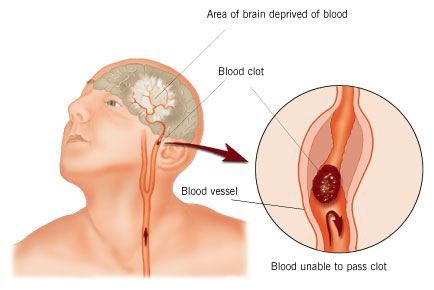 What does a stroke feel like?