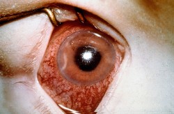 Acute glaucoma can cause rapid loss of vision due to total blockage of the fluid drainage channels (© Community Eye Health)
